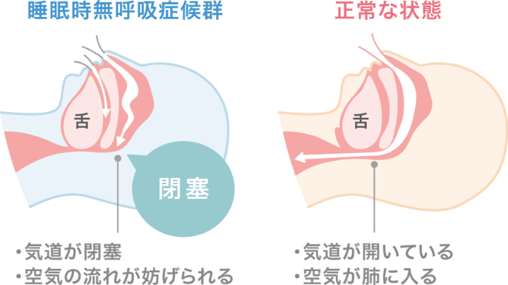 睡眠時無呼吸症候群と正常な状態の頭部側面図